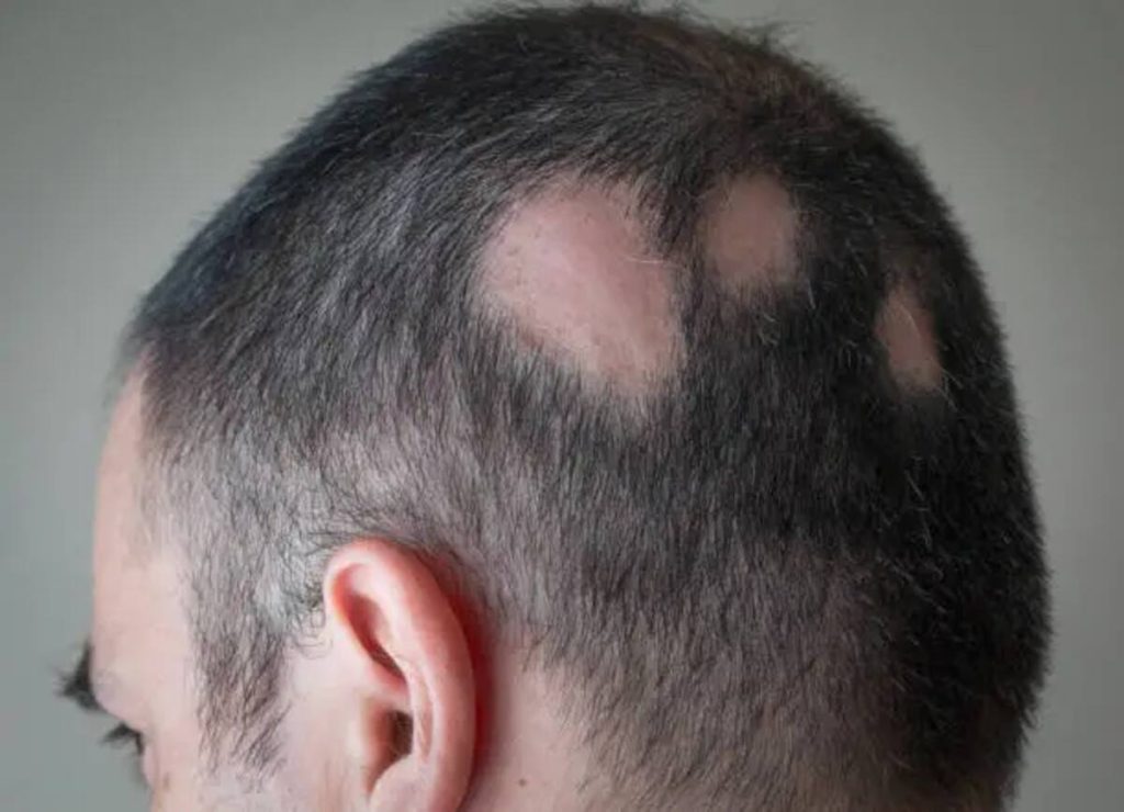 BEST HAIR TRANSPLANT DOCTOR IN ARIZONA