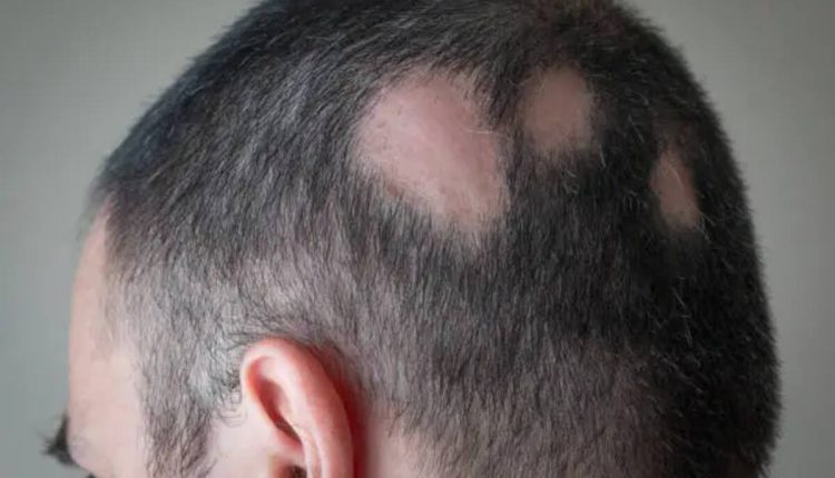 BEST HAIR TRANSPLANT DOCTOR IN ARIZONA