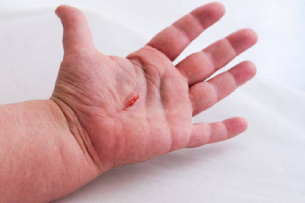 Blisterata