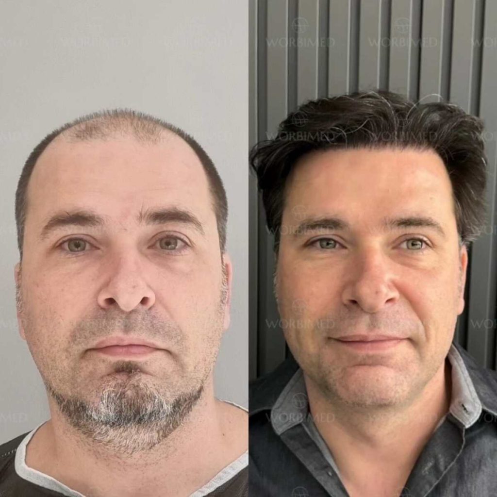 Hair transplant in Turkey cost