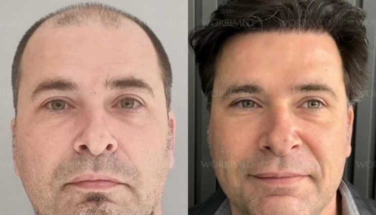 Hair transplant in Turkey cost