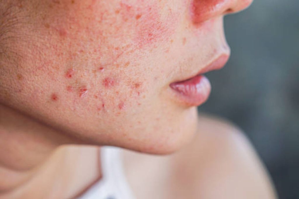 Acne 