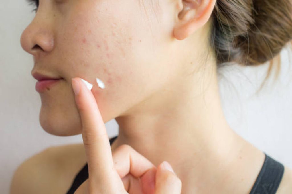 acne care